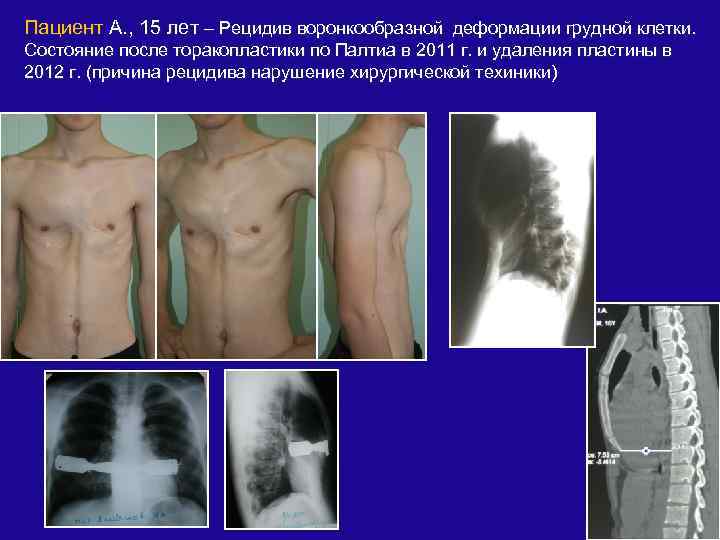 Воронкообразная деформация грудной клетки у ребенка фото