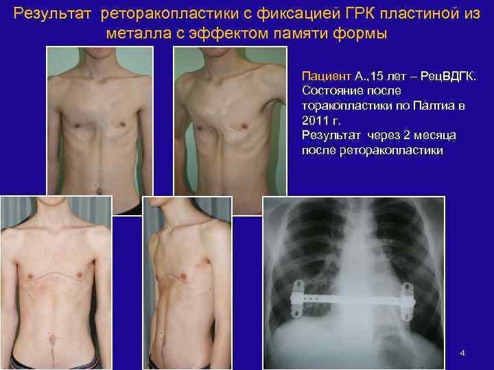 Результат реторакопластики с фиксацией ГРК пластиной из металла с эффектом памяти формы Пациент А.