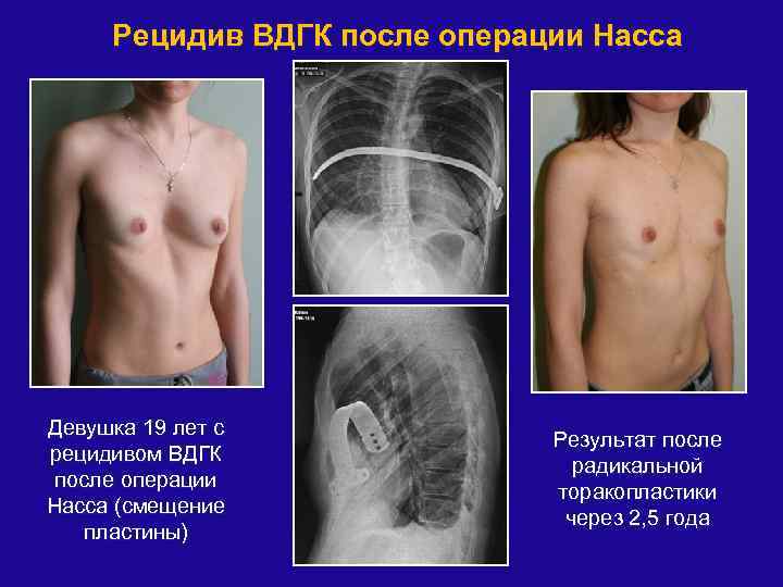 Рецидив ВДГК после операции Насса Девушка 19 лет с рецидивом ВДГК после операции Насса