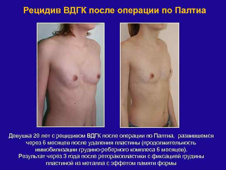 Рецидив ВДГК после операции по Палтиа Девушка 20 лет с рецидивом ВДГК после операции