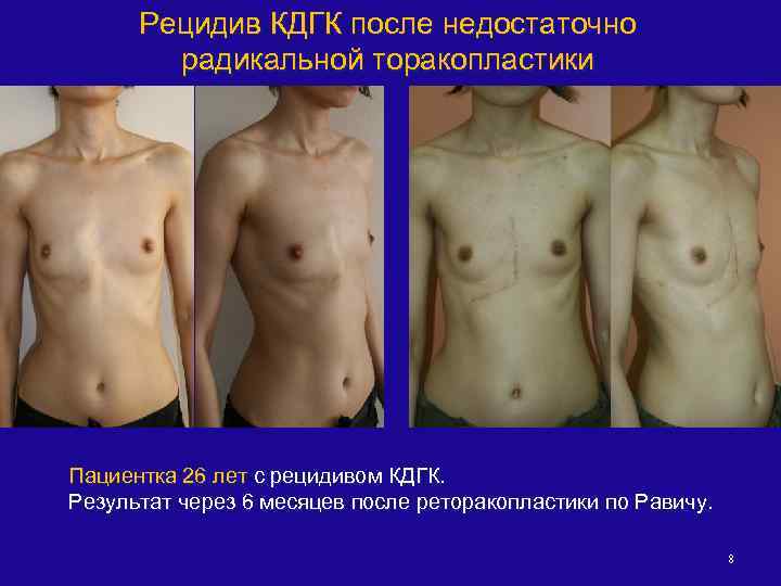 Рецидив КДГК после недостаточно радикальной торакопластики Пациентка 26 лет с рецидивом КДГК. Результат через