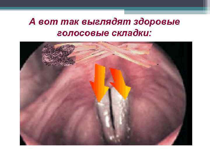 А вот так выглядят здоровые голосовые складки: 