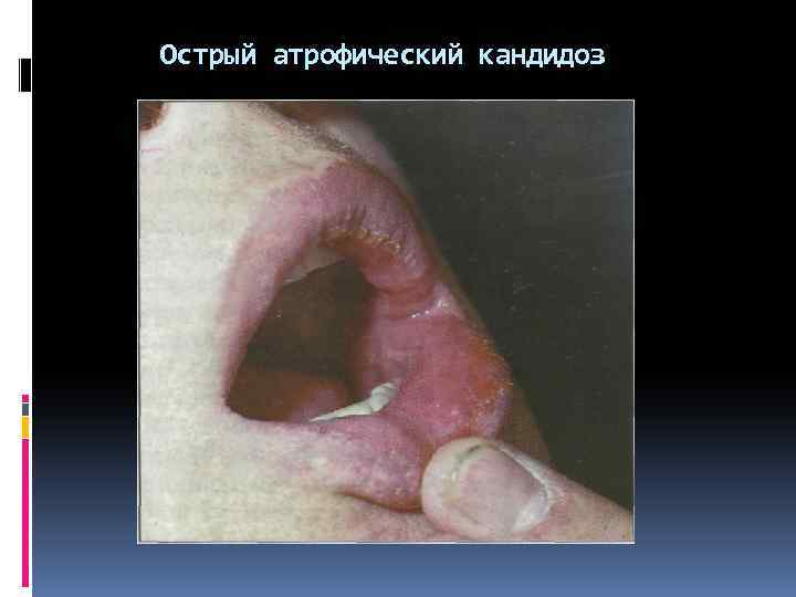 Острый атрофический кандидоз 