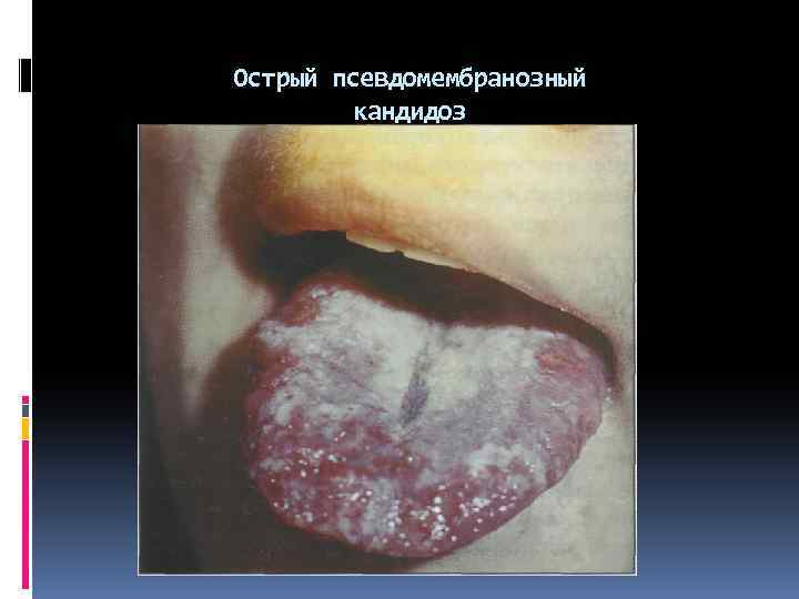 Острый псевдомембранозный кандидоз 