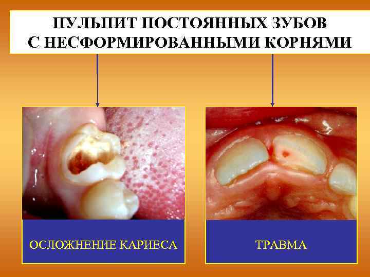 Пульпит у детей фото