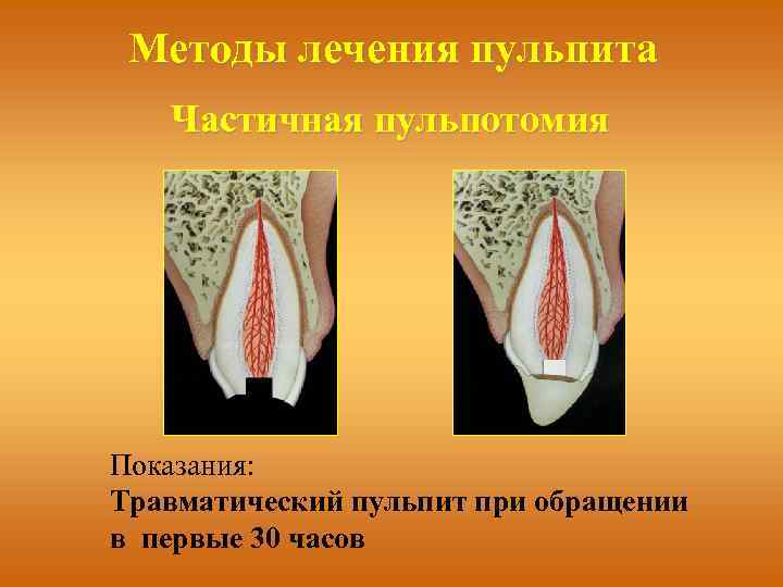 Методы лечения пульпита Частичная пульпотомия Показания: Травматический пульпит при обращении в первые 30 часов