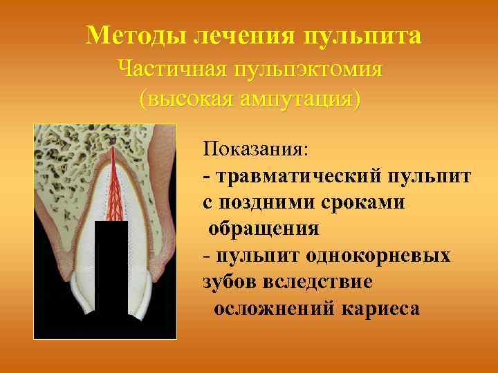 Методы лечения пульпита Частичная пульпэктомия (высокая ампутация) Показания: - травматический пульпит с поздними сроками