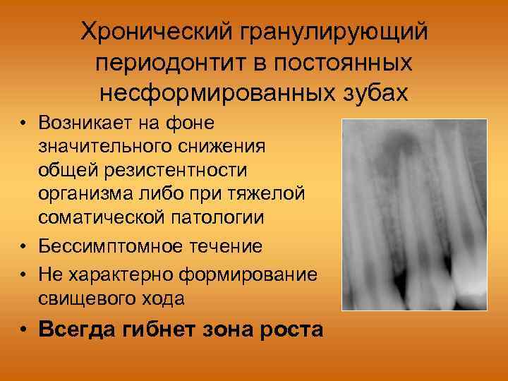 Хронический гранулирующий периодонтит в постоянных несформированных зубах • Возникает на фоне значительного снижения общей