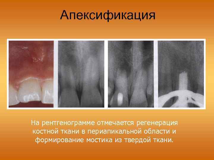 Апексификация На рентгенограмме отмечается регенерация костной ткани в периапикальной области и формирование мостика из