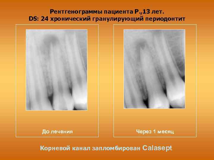 Рентгенограммы пациента Р. , 13 лет. DS: 24 хронический гранулирующий периодонтит До лечения Через