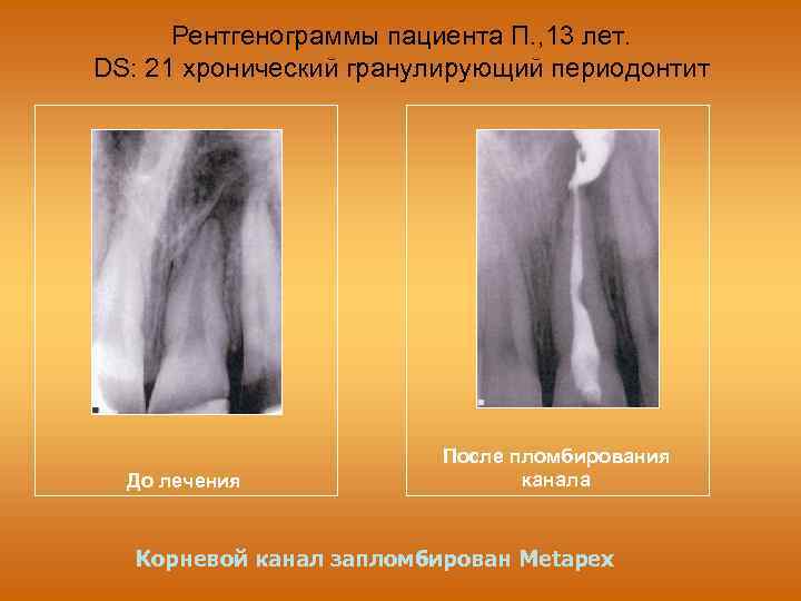 Рентгенограммы пациента П. , 13 лет. DS: 21 хронический гранулирующий периодонтит До лечения После