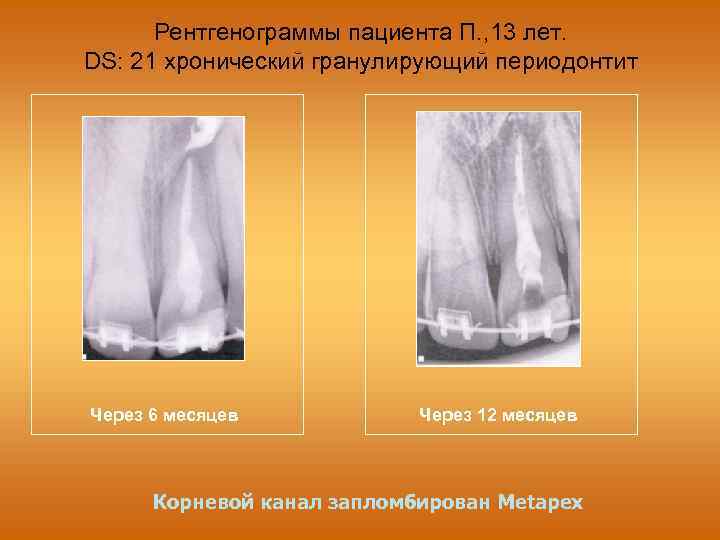 Хронический пульпит презентация