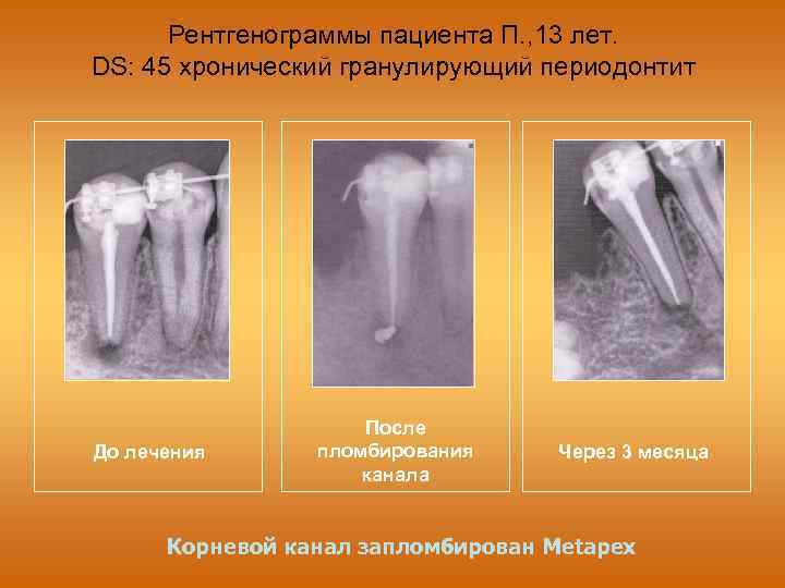 Рентгенограммы пациента П. , 13 лет. DS: 45 хронический гранулирующий периодонтит До лечения После