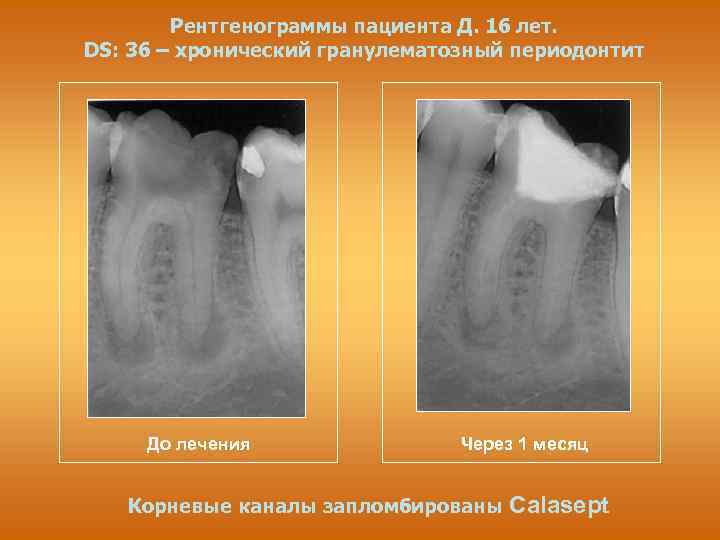 Рентгенограммы пациента Д. 16 лет. DS: 36 – хронический гранулематозный периодонтит До лечения Через