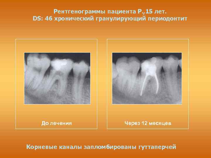 Рентгенограммы пациента Р. , 15 лет. DS: 46 хронический гранулирующий периодонтит До лечения Через