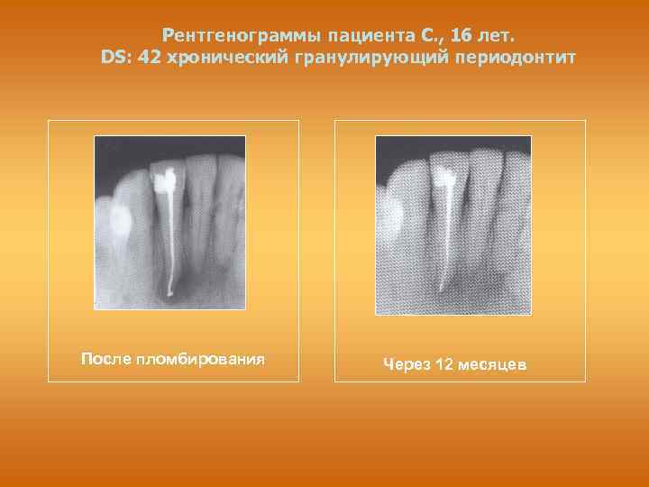 Рентгенограммы пациента С. , 16 лет. DS: 42 хронический гранулирующий периодонтит После пломбирования Через