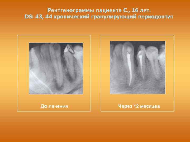 Хронический фиброзный периодонтит лечение. Фиброзный периодонтит рентгенограмма. Гранулематозный периодонтит снимки. Гранулематозный апикальный периодонтит.