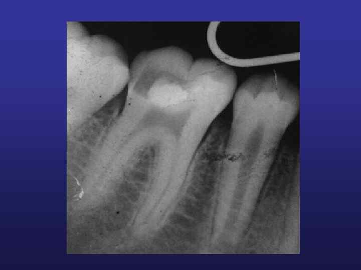 Лечение пульпита постоянных зубов с несформированной верхушкой