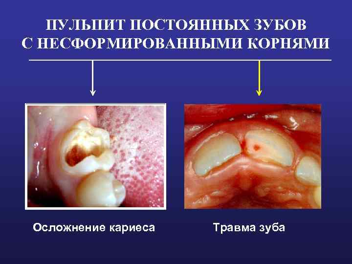 ПУЛЬПИТ ПОСТОЯННЫХ ЗУБОВ С НЕСФОРМИРОВАННЫМИ КОРНЯМИ Осложнение кариеса Травма зуба 