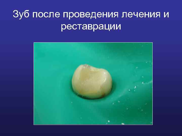 Зуб после проведения лечения и реставрации 