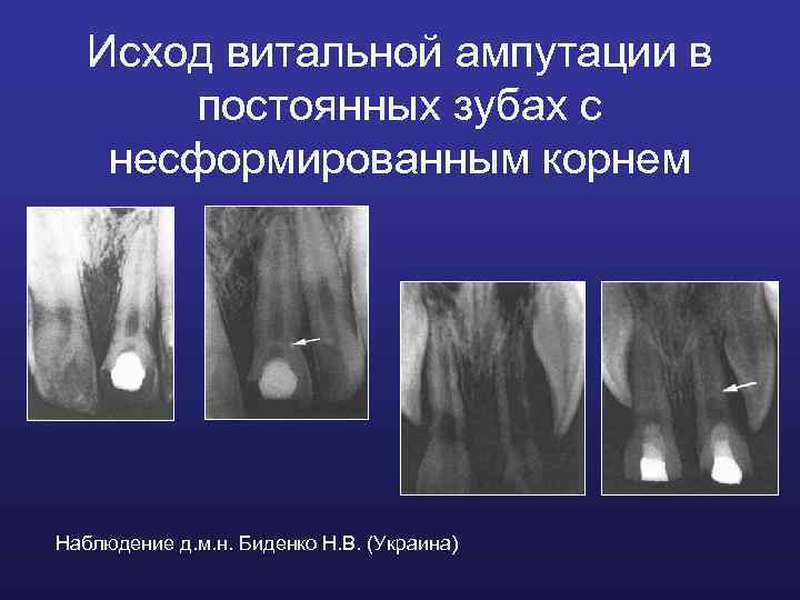 Исход витальной ампутации в постоянных зубах с несформированным корнем Наблюдение д. м. н. Биденко