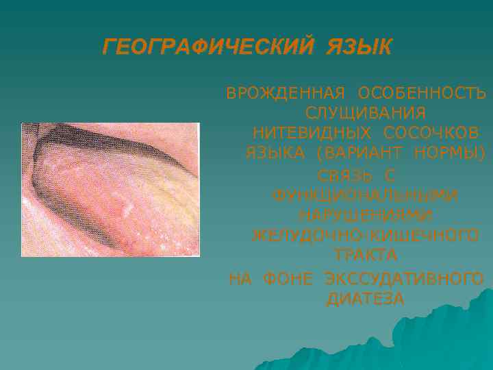 ГЕОГРАФИЧЕСКИЙ ЯЗЫК ВРОЖДЕННАЯ ОСОБЕННОСТЬ СЛУЩИВАНИЯ НИТЕВИДНЫХ СОСОЧКОВ ЯЗЫКА (ВАРИАНТ НОРМЫ) СВЯЗЬ С ФУНКЦИОНАЛЬНЫМИ НАРУШЕНИЯМИ