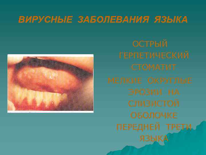 ВИРУСНЫЕ ЗАБОЛЕВАНИЯ ЯЗЫКА ОСТРЫЙ ГЕРПЕТИЧЕСКИЙ СТОМАТИТ МЕЛКИЕ ОКРУГЛЫЕ ЭРОЗИИ НА СЛИЗИСТОЙ ОБОЛОЧКЕ ПЕРЕДНЕЙ ТРЕТИ