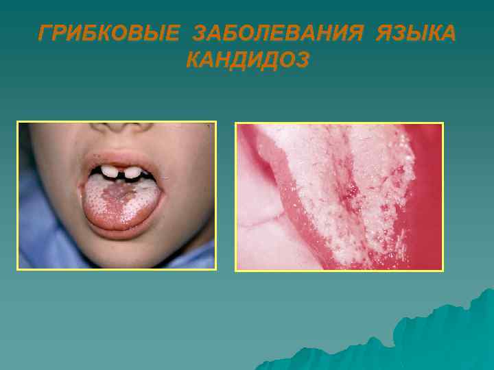 ГРИБКОВЫЕ ЗАБОЛЕВАНИЯ ЯЗЫКА КАНДИДОЗ 