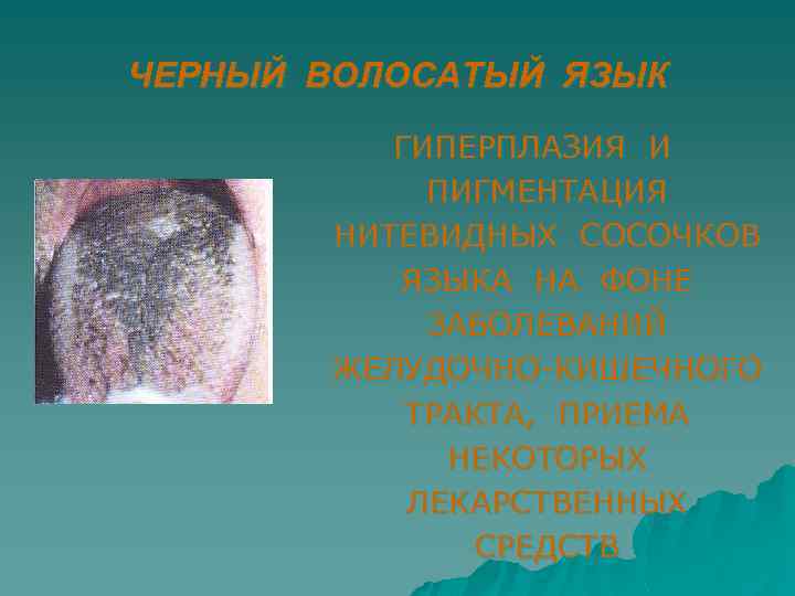 ЧЕРНЫЙ ВОЛОСАТЫЙ ЯЗЫК ГИПЕРПЛАЗИЯ И ПИГМЕНТАЦИЯ НИТЕВИДНЫХ СОСОЧКОВ ЯЗЫКА НА ФОНЕ ЗАБОЛЕВАНИЙ ЖЕЛУДОЧНО-КИШЕЧНОГО ТРАКТА,