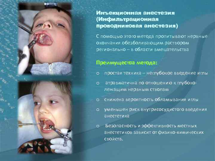 Инъекционная анестезия (Инфильтрационная проводниковая анестезия) С помощью этого метода пропитывают нервные окончания обезболивающим раствором