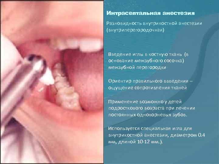 Интрасептальная анестезия Разновидность внутрикостной анестезии (внутриперегородочная) Введение иглы в костную ткань (в основание межзубного