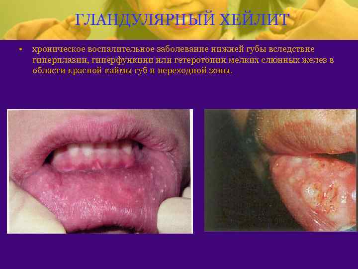 ГЛАНДУЛЯРНЫЙ ХЕЙЛИТ • хроническое воспалительное заболевание нижней губы вследствие гиперплазии, гиперфункции или гетеротопии мелких
