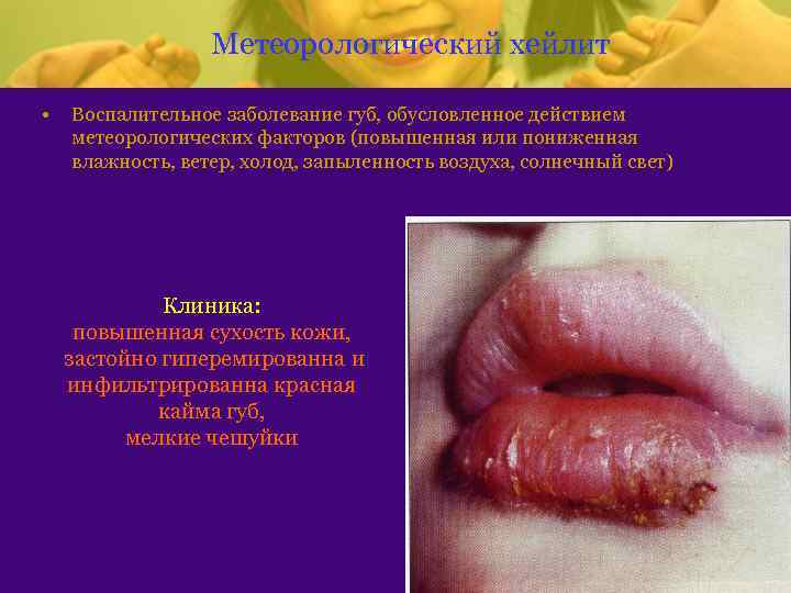 Метеорологический хейлит • Воспалительное заболевание губ, обусловленное действием метеорологических факторов (повышенная или пониженная влажность,