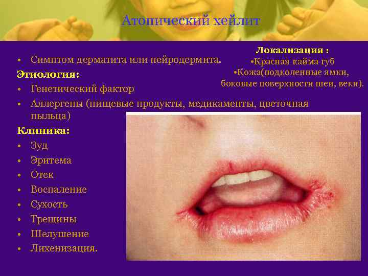 Атопический хейлит Локализация : • Симптом дерматита или нейродермита. • Красная кайма губ •