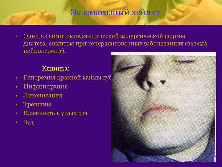 Экзематозный хейлит • Один из симптомов атопической аллергической формы диатеза, симптом при генерализованных заболеваниях