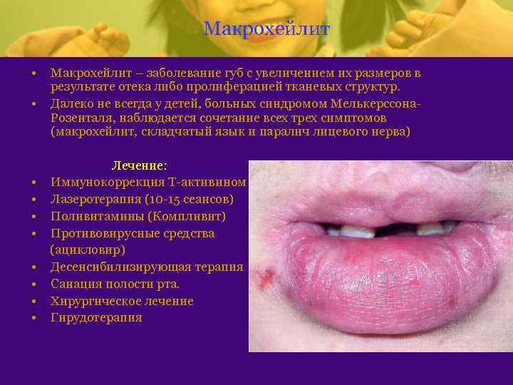 Макрохейлит • • • Макрохейлит – заболевание губ с увеличением их размеров в результате