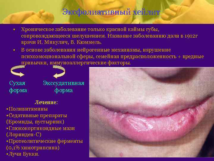 Эксфолиативный хейлит • • Хроническое заболевание только красной каймы губы, сопровождающееся шелушением. Название заболеванию