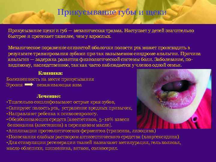 Прикусывание губы и щеки Прикусывание щеки и губ — механическая травма. Наступает у детей