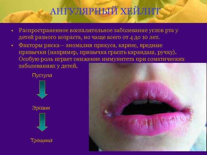 АНГУЛЯРНЫЙ ХЕЙЛИТ • Распространенное воспалительное заболевание углов рта у детей разного возраста, но чаще
