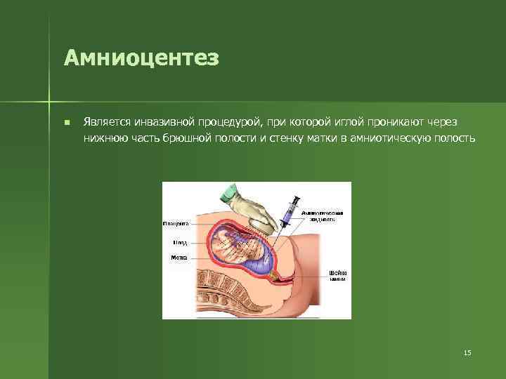 Амниоцентез n Является инвазивной процедурой, при которой иглой проникают через нижнюю часть брюшной полости