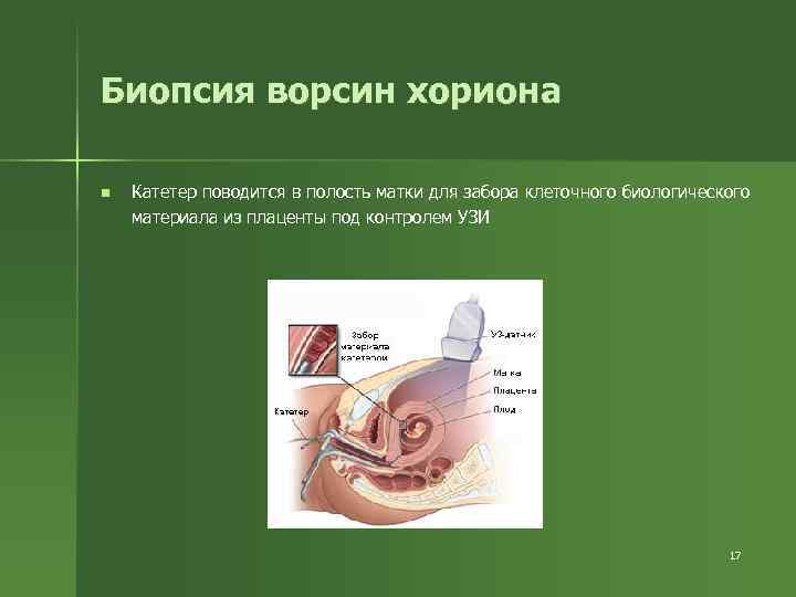 Биопсия ворсин хориона n Катетер поводится в полость матки для забора клеточного биологического материала