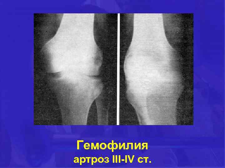 Гемофилия артроз III-IV ст. 