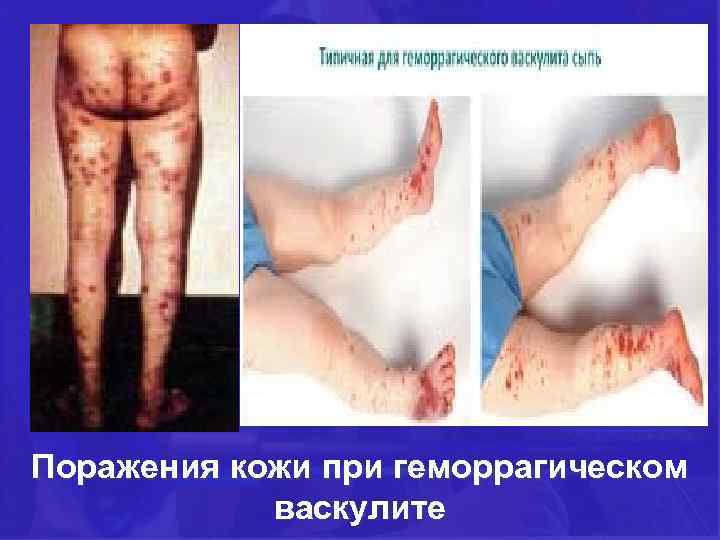 Поражения кожи при геморрагическом васкулите 