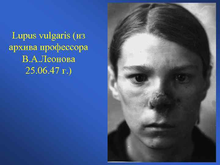 Lupus vulgaris (из архива профессора В. А. Леонова 25. 06. 47 г. ) 