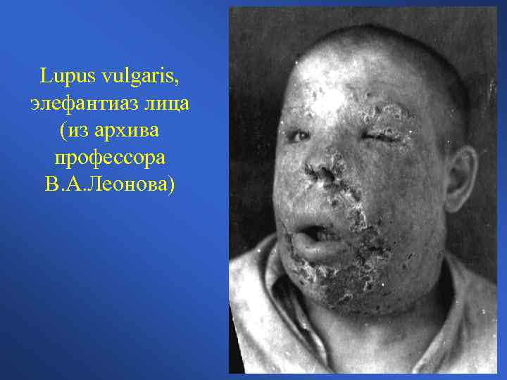 Lupus vulgaris, элефантиаз лица (из архива профессора В. А. Леонова) 