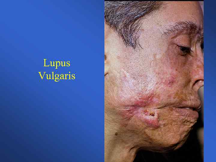 Lupus Vulgaris 