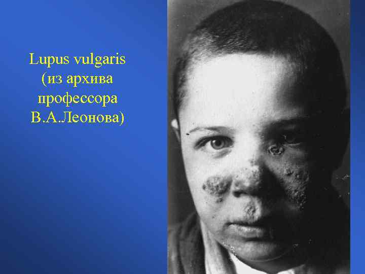Lupus vulgaris (из архива профессора В. А. Леонова) 