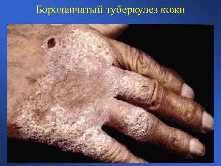 Бородавчатый туберкулез кожи 