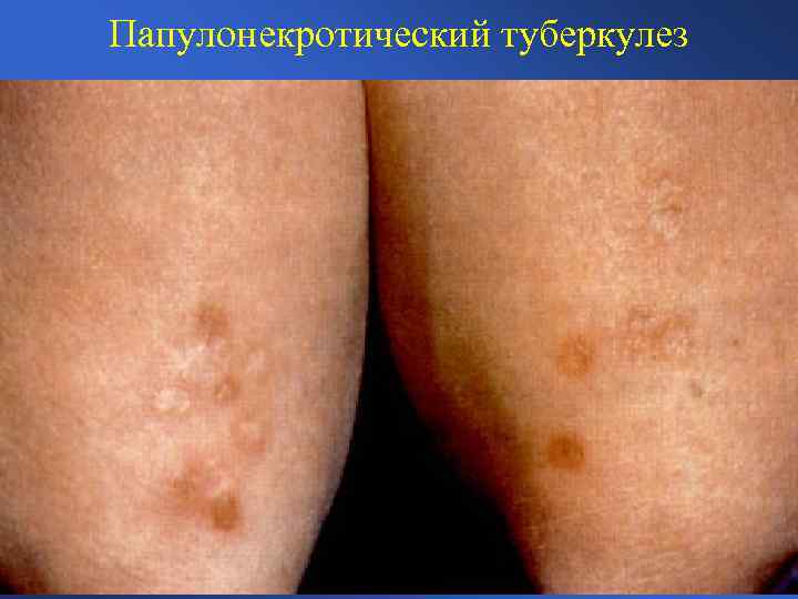 Папулонекротический туберкулез 