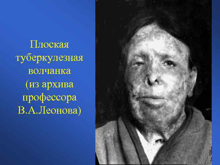 Плоская туберкулезная волчанка (из архива профессора В. А. Леонова) 